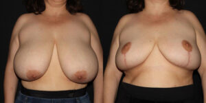 kaweski-san-diego-breast-reduction-patient-10-1