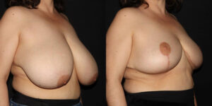 kaweski-san-diego-breast-reduction-patient-10-2