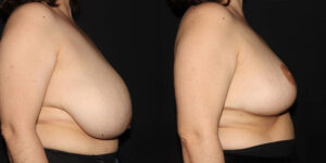 kaweski-san-diego-breast-reduction-patient-10-3