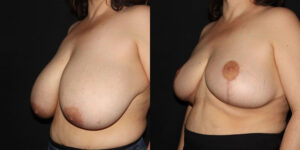 kaweski-san-diego-breast-reduction-patient-10-4