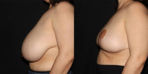 kaweski-san-diego-breast-reduction-patient-10-5