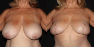 kaweski-san-diego-breast-reduction-patient-patient-11-1