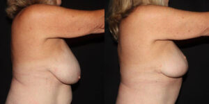 kaweski-san-diego-breast-reduction-patient-patient-11-3